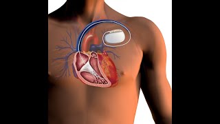 AICD  Automated Implantable Cardioverter  Defibrillator  Pacer  Dr Rams Medical Coding Academy [upl. by Akiram285]