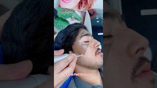 Carbon Peel Laser getsmarthairclub viralvideo beauty [upl. by Corny35]