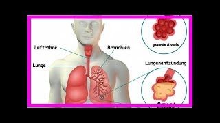 Lungenentzündung Symptome und unterstützende Naturheilmittel [upl. by Jobie]