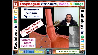 How to differentiate between sophageal stricture webs and rings 7 radiology in GIT [upl. by Campagna551]