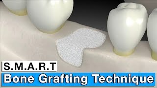 Bone Grafting  MinimallyInvasive SMART Bone Graft [upl. by Nauj]