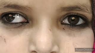 Intermittent exotropia decompensated [upl. by Corwun60]