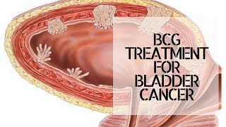 BCG TREATMENT FOR BLADDER CANCER [upl. by Assirec932]