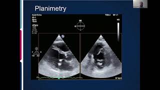 Joint Echo Conference Mitral Stenosis [upl. by Eirrehs]