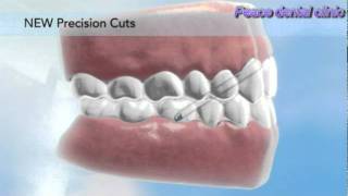 Invisalign Precision cuts [upl. by Aronoff]