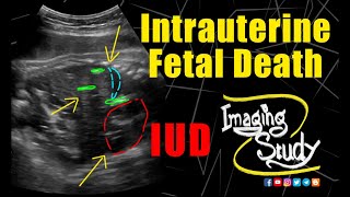 Intrauterine Fetal Death  IUD  36 Week  Ultrasound  Case 209 [upl. by Lleon146]