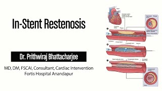 INSTENT RESTENOSIS [upl. by Sarene325]