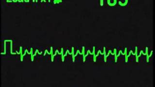 Supraventricular Tachycardia  SVT  ECG Simulator  Arrhythmia Simulator [upl. by Pressman]