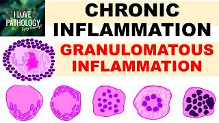 INFLAMMATION Part 9 Chronic Inflammation  GRANULOMATOUS INFLAMMATION [upl. by Hcir]