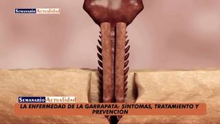 La enfermedad de la garrapata Síntomas tratamiento y prevención [upl. by Acinnor]