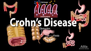 Crohns Disease Pathophysiology Symptoms Risk factors Diagnosis and Treatments Animation [upl. by Libbi]