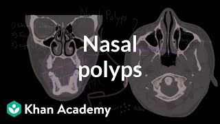 Colorectal polyps  an Osmosis Preview [upl. by Maise]