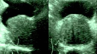 BIOPSIA DE PROSTATA GUIADA POR ULTRASONIDO [upl. by Murrah]