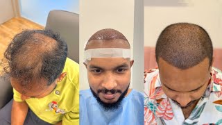 My Hair Transplant Journey 💇🏽 [upl. by Fiester]