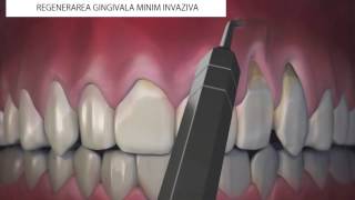 Regenerare gingivala minim invaziva [upl. by Niarfe]