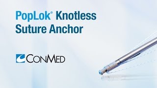 PopLok® Knotless Suture Anchor  ConMed Product Video [upl. by Katrina535]