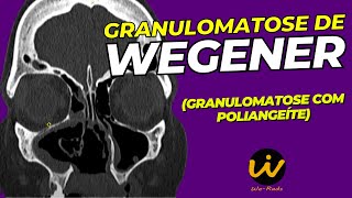 GRANULOMATOSE de WEGENER  Granulomatose com Poliangeíte [upl. by Martinelli]