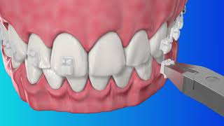 3M Clarity Ultra Bracket Debonding Demo [upl. by Yema807]