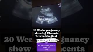 20 Weeks Pregnancy showing Placenta Previa On Ultrasound [upl. by Ainel]