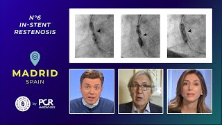 A patient with stent failure  how should I treat instent restenosis  Webinar [upl. by Aninaig]