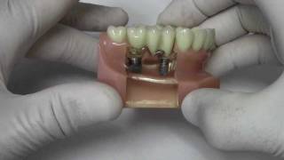 Implant Crown amp Bridge  Model Demonstration [upl. by Aznofla]