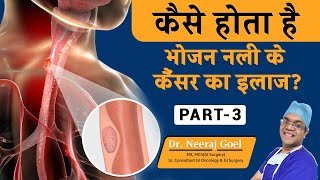 भोजन नली के कैंसर का इलाज  Treatment of Esophageal Cancer  Dr Neeraj Goel Part  3 [upl. by Assirralc]