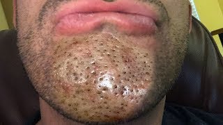 WARNING Blackheads amp Dilated Pores of Winer  Bubu Plus Documentary [upl. by Asilej]