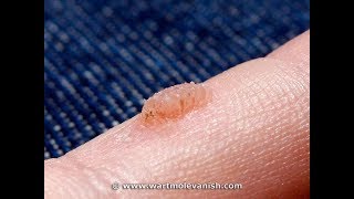 How to Remove Common Hand Warts  Wart amp Mole Vanish [upl. by Ahearn]