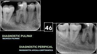 46 Treatment Necrosis Simptomatic Apical Periodontitis [upl. by Dollar]