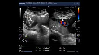 Anencephaly with a pregnancy of about 17 weeks 02 days [upl. by Ahsiekim]