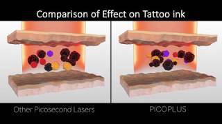 Luntronic PICOPLUS Laser FDA approved Picosecond amp Nanosecond Platform [upl. by Publius393]