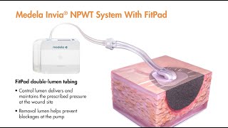 Medela Intelligent Pressure Control and Dynamic Exudate Removal with Captions [upl. by Lundt111]