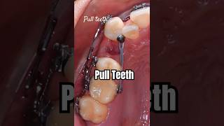 How to pull teeth when braces braces orthodontist dentist dental [upl. by Nidia]