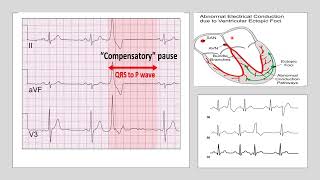 Compensatory pause occurs after Extrasystole by Prof Dr Sanhita Mukherjee [upl. by Kelsey]