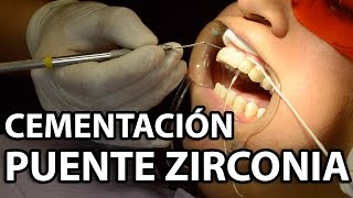 Cementación Puente Zirconia 6 Unidades👅Parte2 [upl. by Assilak]