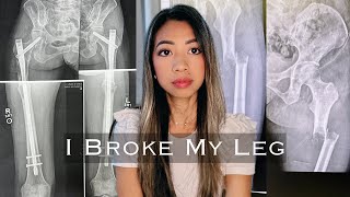 My 1 Year Recovery from Bilateral Femur Fixation Surgeries  Living with Stage 4 Cancer [upl. by Egiap]