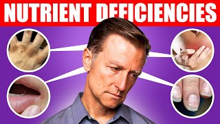 The 5 Nutrient Deficiencies Behind Depression [upl. by Initirb899]