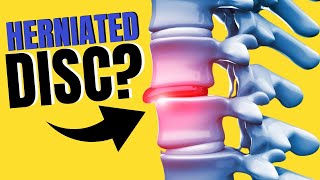 Wonder if you have a Herniated Disc Try this One Simple Test [upl. by Eiramesor]