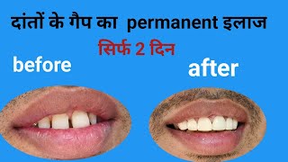 दांतो के गैप को कैसे ठीक करेंpermanent teeth gap close just in 2 daysteeth spacingE max crown [upl. by Angrist]