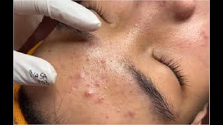 Satisfying And Relaxation with NaSa Beauty Spa 44 blackhead and acne extraction [upl. by Marabel672]