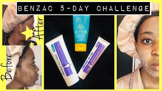 I TRIED BENZOYL PEROXIDE BENZAC AC5 FOR A WEEK BENZOYL PEROXIDE REVIEW BENZOYL PEROXIDE FOR ACNE [upl. by Thane]