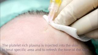 Treatment of Melasma Live Procedure with Facial PRP Therapy and Microneedling by Facial Surgeon1 [upl. by Nyrac]