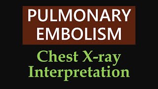 Pulmonary Embolism  Chest Xray Interpretation [upl. by Odraode761]