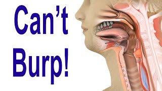 Inability to Burp Retrograde Cricopharyngeus Dysfunction RCPD [upl. by Margie612]