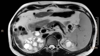 Contrastenhanced harmonic EUS–guided radiofrequency ablation of hepatocellular carcinoma [upl. by Lemrej]