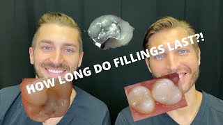 How Long Do Fillings Last [upl. by Abixah]