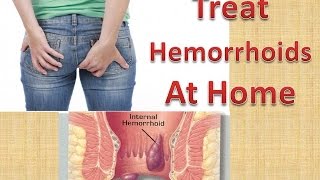 How To Treat HEMORRHOIDS At Home Quickly amp Naturally Without Surgery [upl. by Ecirahc655]