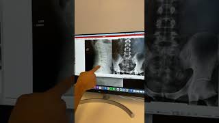 Dr Mike  Spondylolisthesis XRay Evaluation and Adjustment [upl. by Annoel]