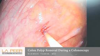 Colonic polyps and Colon Adenomas  Pathology [upl. by Asilam]