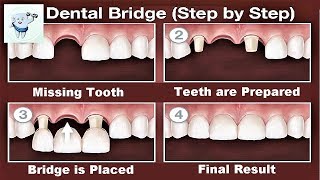 Dental Bridge Procedure Step by Step [upl. by Wilow177]